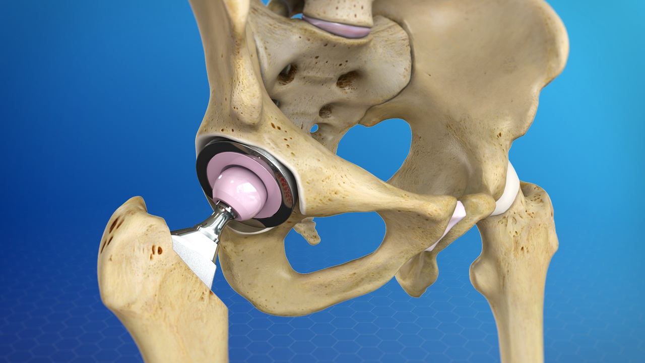 Ceramic Hip resurfacing 