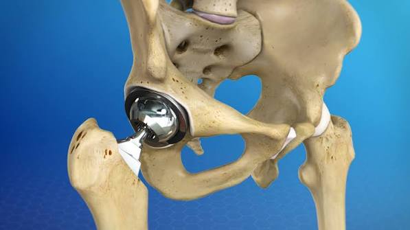 Hip Replacement