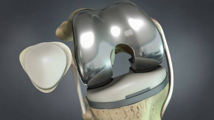 Knee Resurfacing