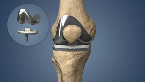 Orthopedic