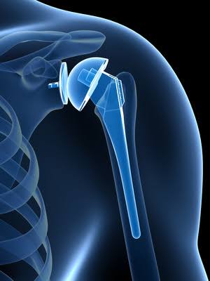 Shoulder Replacement